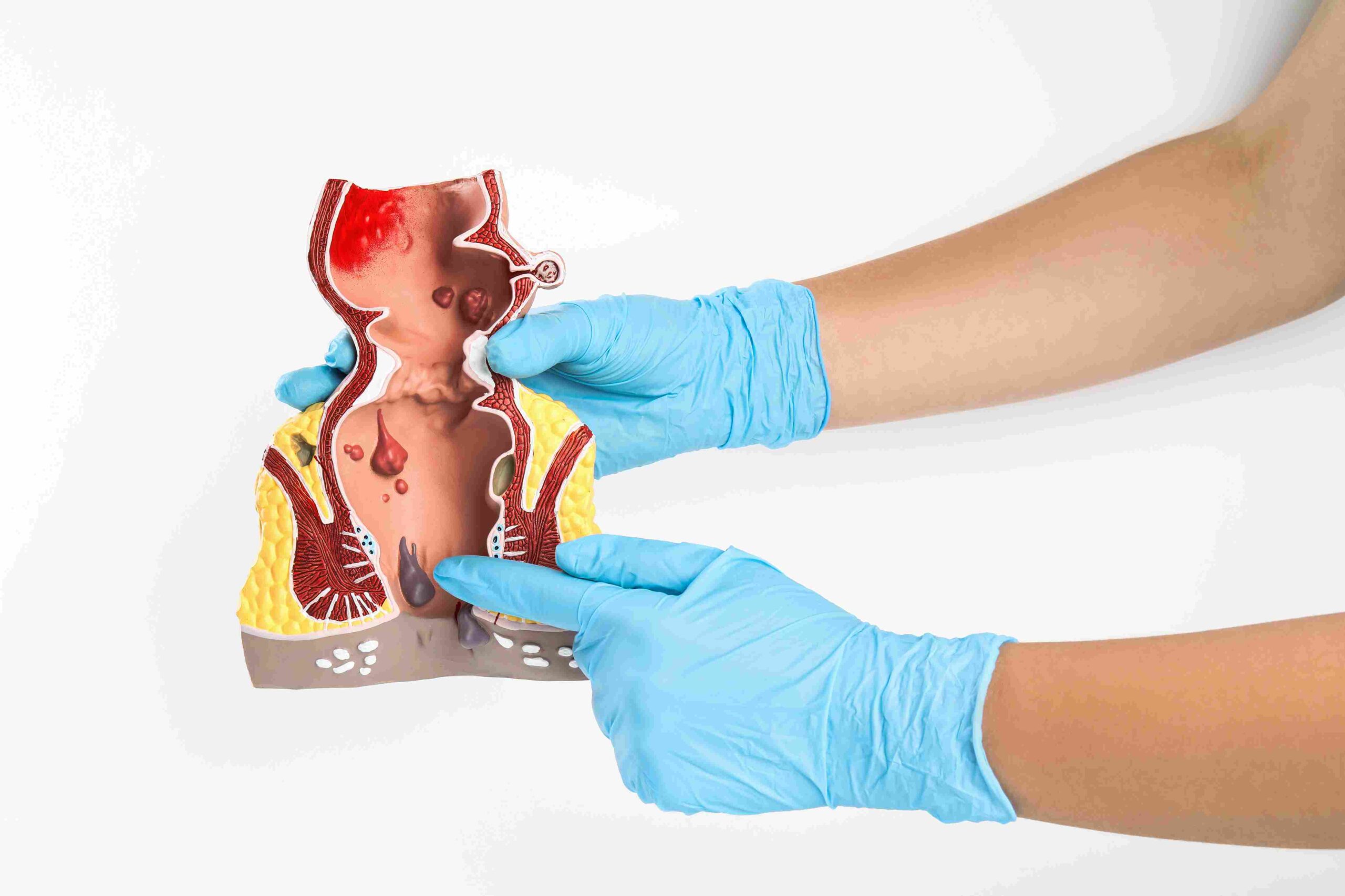 Medicinski model analnog područja koji prikazuje hemoroide, dok ruke u rukavicama ukazuju na problematična mesta